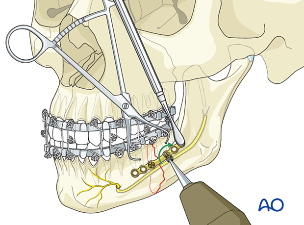 Insertion of the second screw