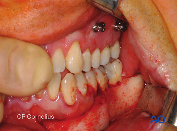 The longitudinal exposure reaches from the lateral symphysis into the angle region