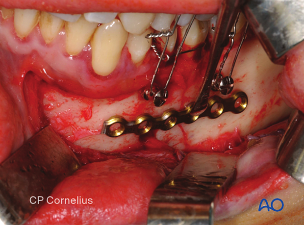 Implant selection