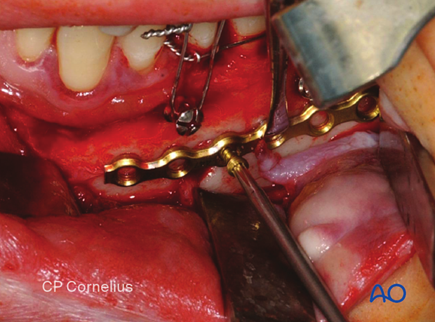 Insertion of first scrwe