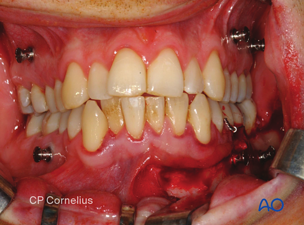 Occlusal check