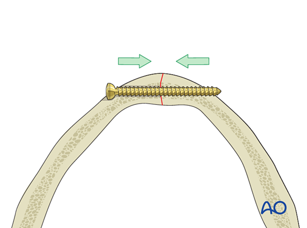 Lag scrwe insertion insagittal fracture