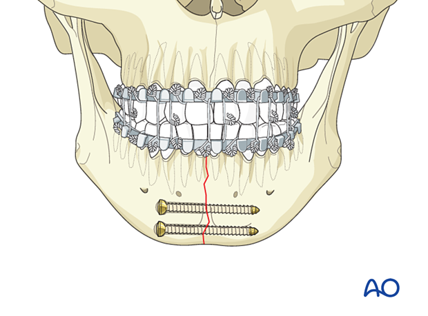 Two lag screws inserted