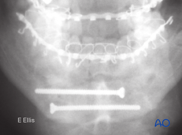 X-ray of completed osteosynthesis