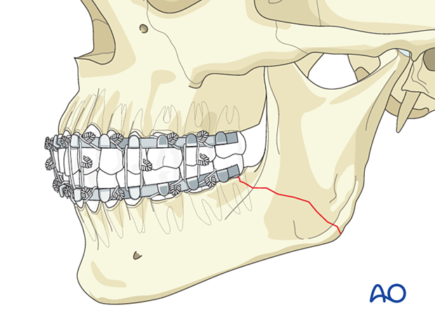 placing the patient into occlusion and securing the MMF