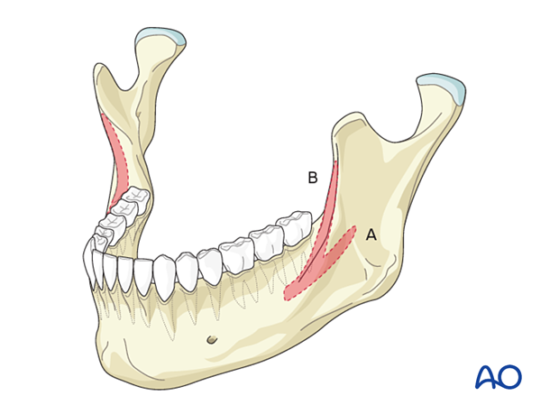 Champy's ideal line of osteosynthesis