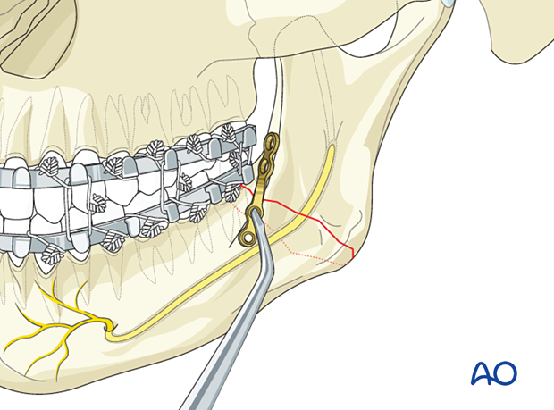 Apply the plate to the bone spanning the fracture