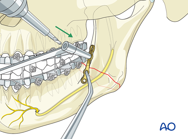 Apply the screw just posterior to the fracture first