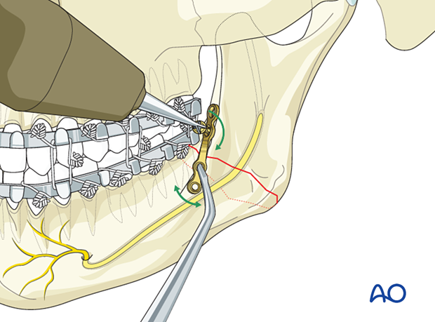 Insert a 6 mm screw and tighten it loosely