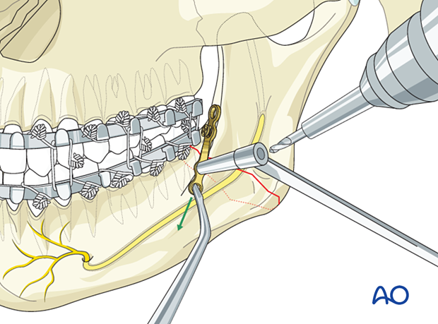 Drag the plate/ramus anteriorly with a point of a periosteal elevator and move it up or down until it is seated flush with the buccal cortex