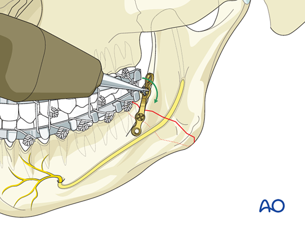 Insert the second screw and tighten it.