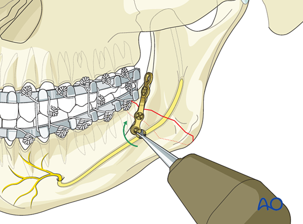 Drill a hole through the most anterior plate hole. Insert and tighten the screw.