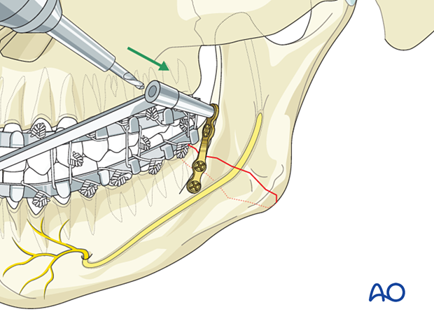 Insertion of final screw