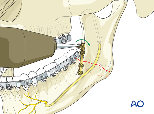 The last screw is inserted and tightened.