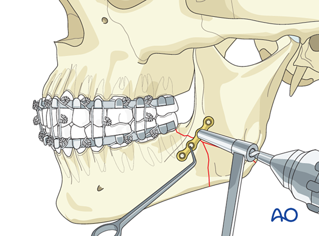 Drilling first screw hole in simplification plate