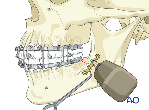 Insertio of first screw in simplification plate