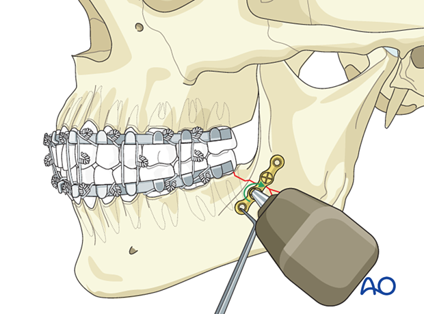 Insertion of second screw in simplification plate