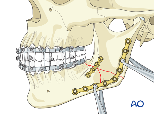 Placement of lower boarder plate