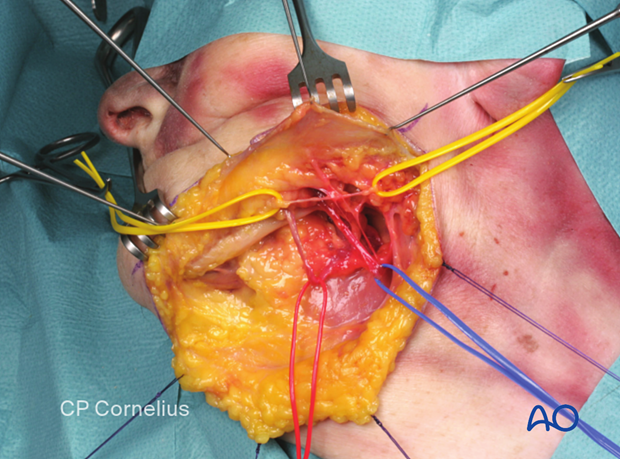 The facial artery is always located anterior to the facial vein.