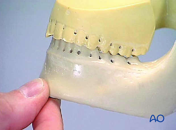 Check of occlusion