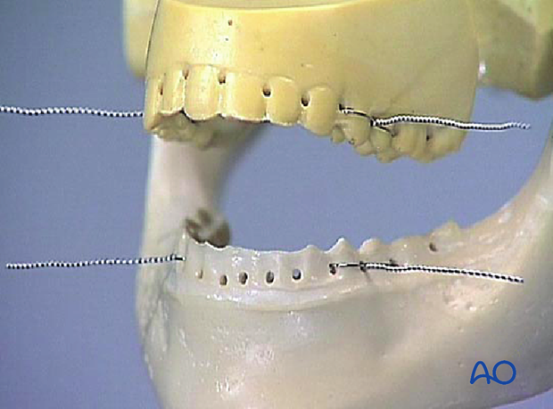 Add ligatures in the same way in the other three sections of the dental arches to form two symmetrical pairs.