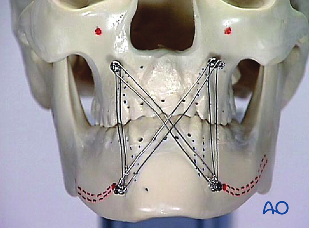 Bone supported MMF implemented on drybone