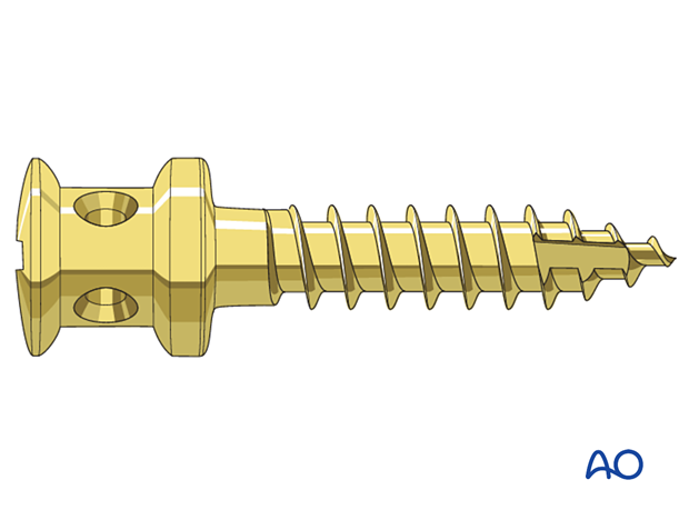 IMF screw design