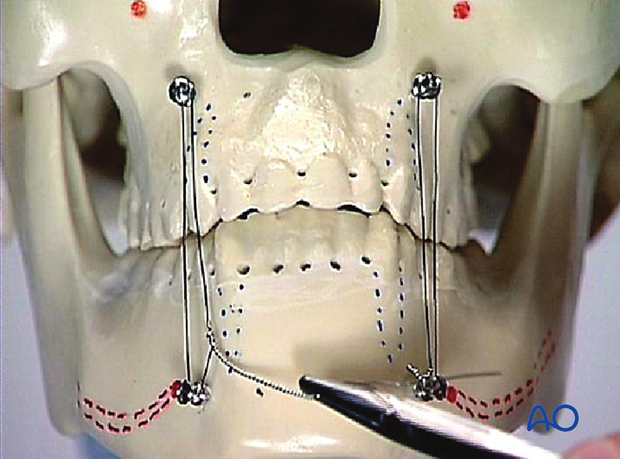 Tightening of second wire