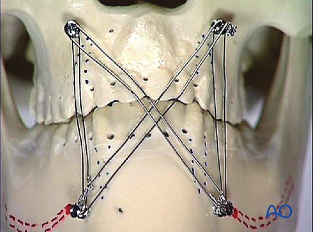 91 X010 maxillomandibular fixation