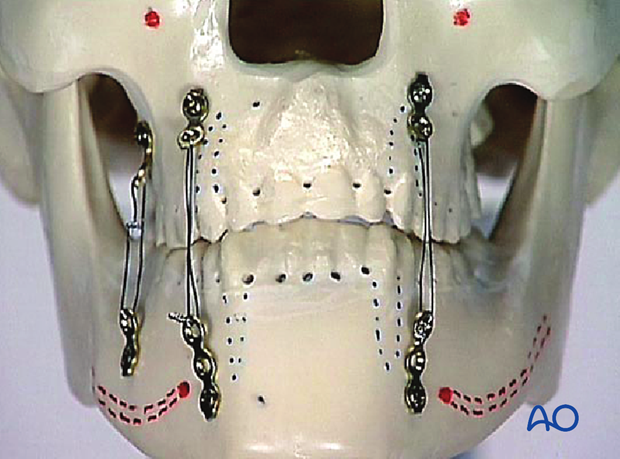 Use of plate instead of MMF screws