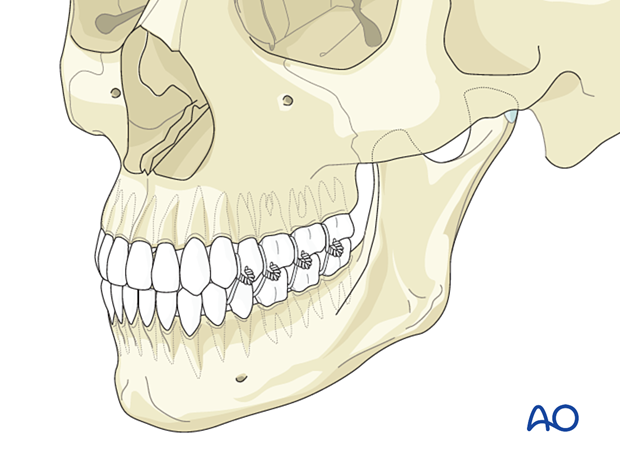 Final application of intradental wires