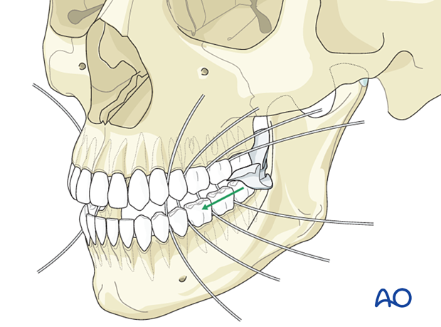 Throat pack brought to the retromolar recess