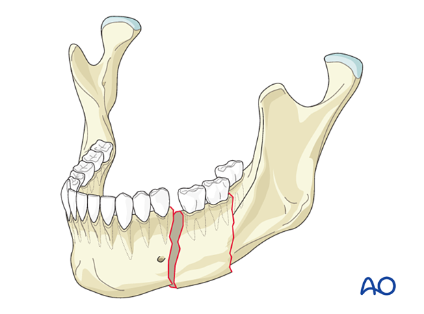 Segmental fracture