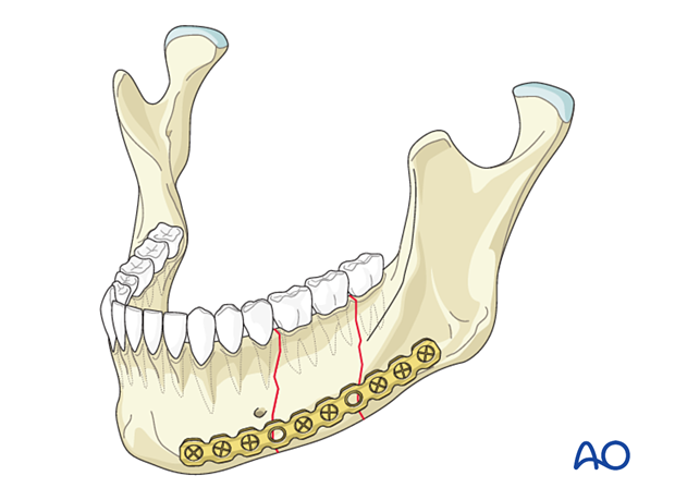 Segmental fracture fixed with on long reconstruction plate