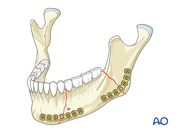 Segmental fracture fixed with two reconstruction plates