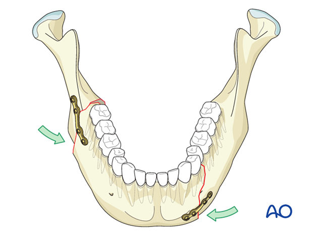 Bilateral fracture