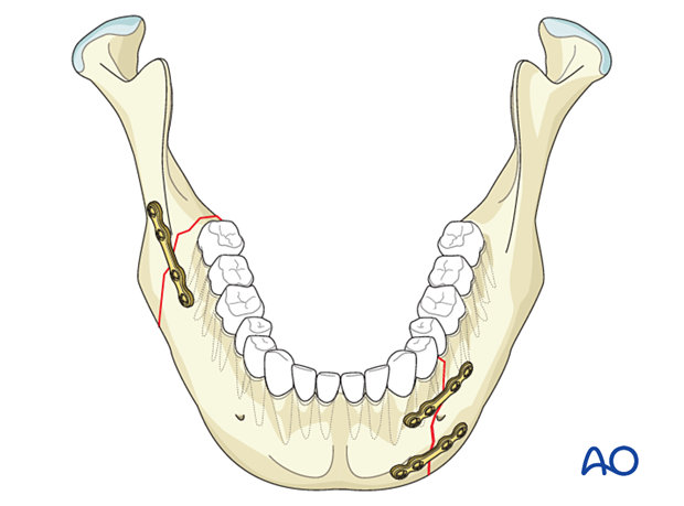 bilteral fracture fixed with miniplates