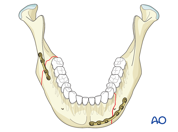 Simple right-angle fracture fixed with a miniplate in the external oblique line and simple left body fracture fixed utilizing a large profile locking plate 2.0 plate.