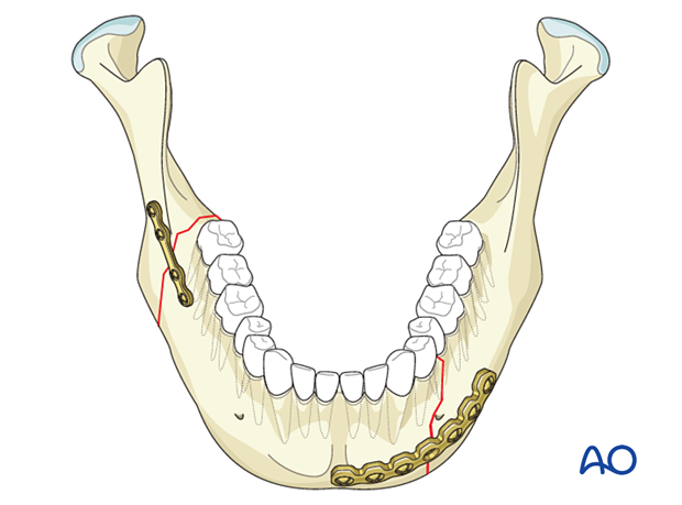 A simple right-angle fracture fixed with a miniplate in the external oblique line and a left body fracture fixed utilizing 2.4 reconstruction plate.