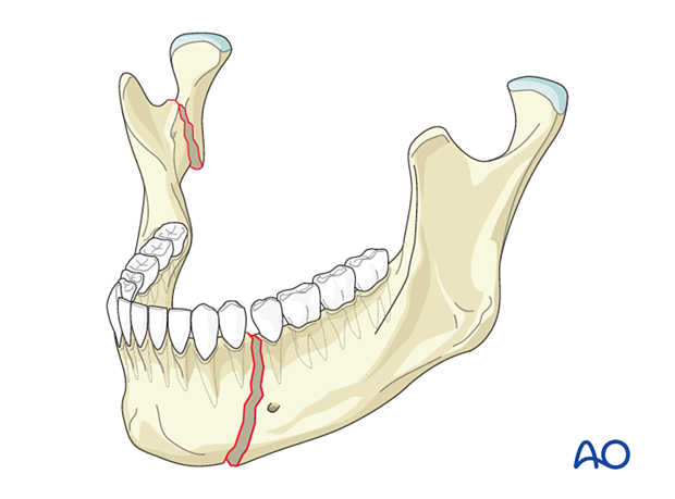 Fractures with contralateral condylar fractures