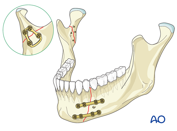 Fixation of the symphysis