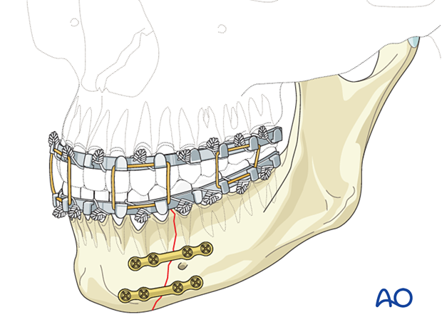 Use of training elastics