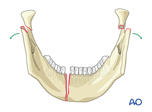 Bilateral condylar fractures with symphysis/anterior body fracture