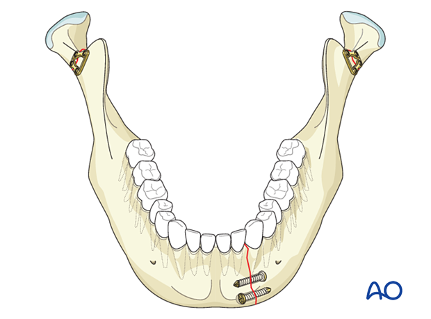 The condylar fractures fixed