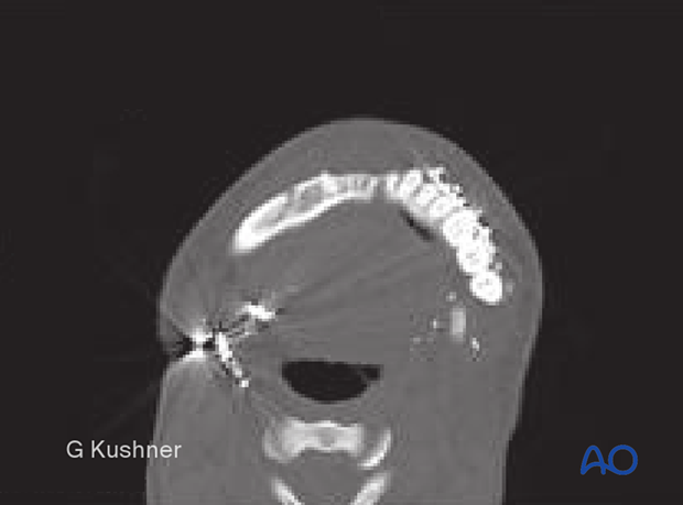 Mandibular widening