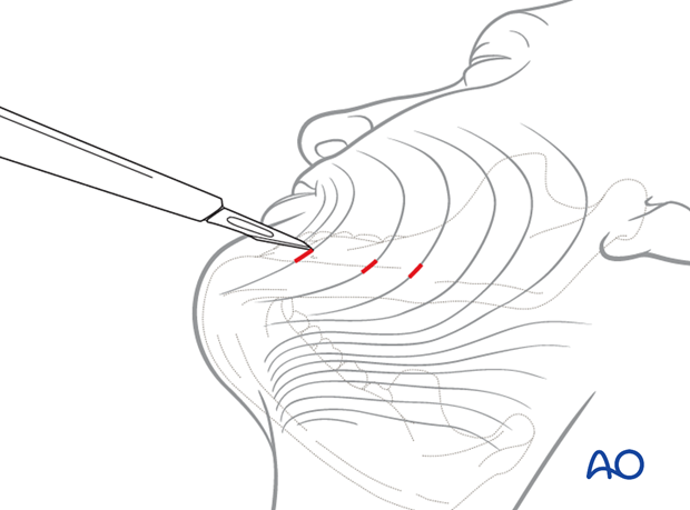 Stab incision