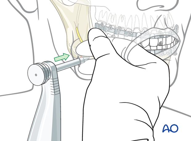 Insertion of cannula with trochar