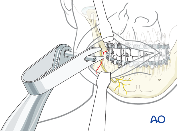 Use of U shaped retractor