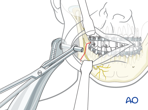 Use of forceps cheek retractor