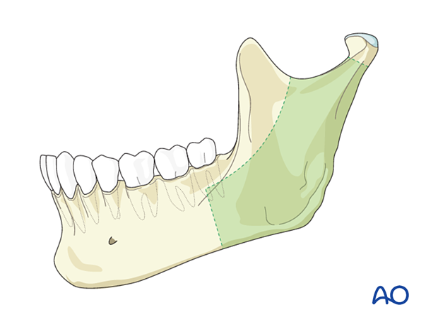 The mandibular area where the angulated screwdriver is useful